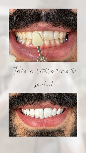 blanchiment dentaire