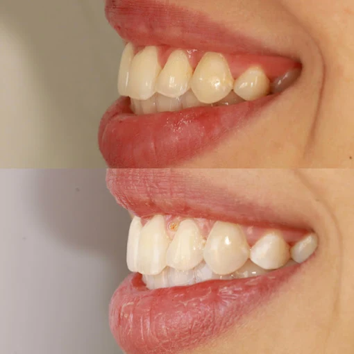 Blanchiment dentaire en 2026 : quelles nouvelles techniques pour des dents plus blanches ?