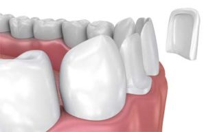 Facettes en composite