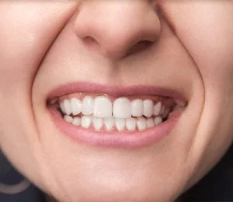 restauration-esthetique-dentaire