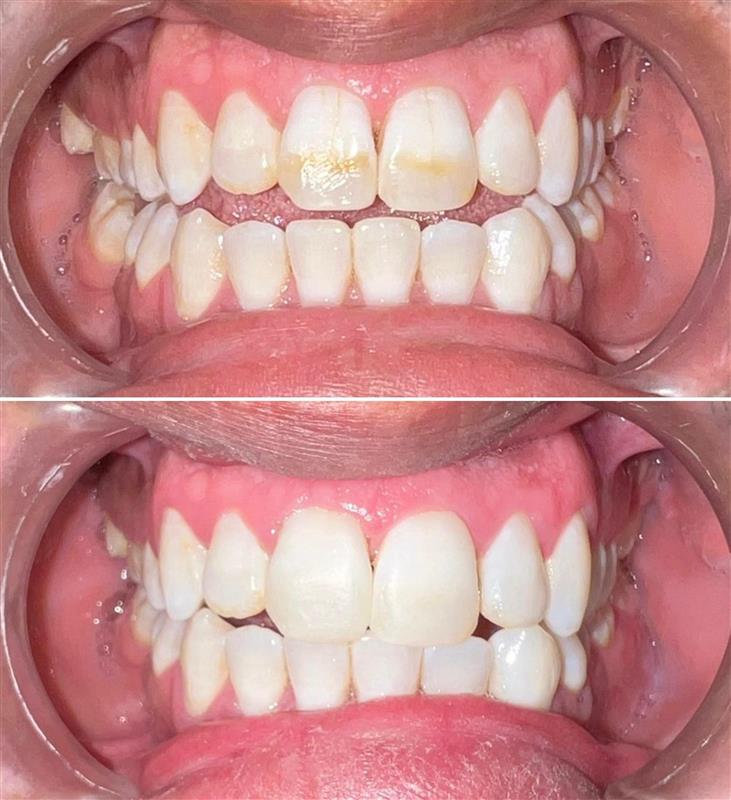 restaurations invisibles