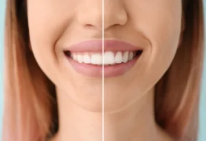 remodelage du sourire