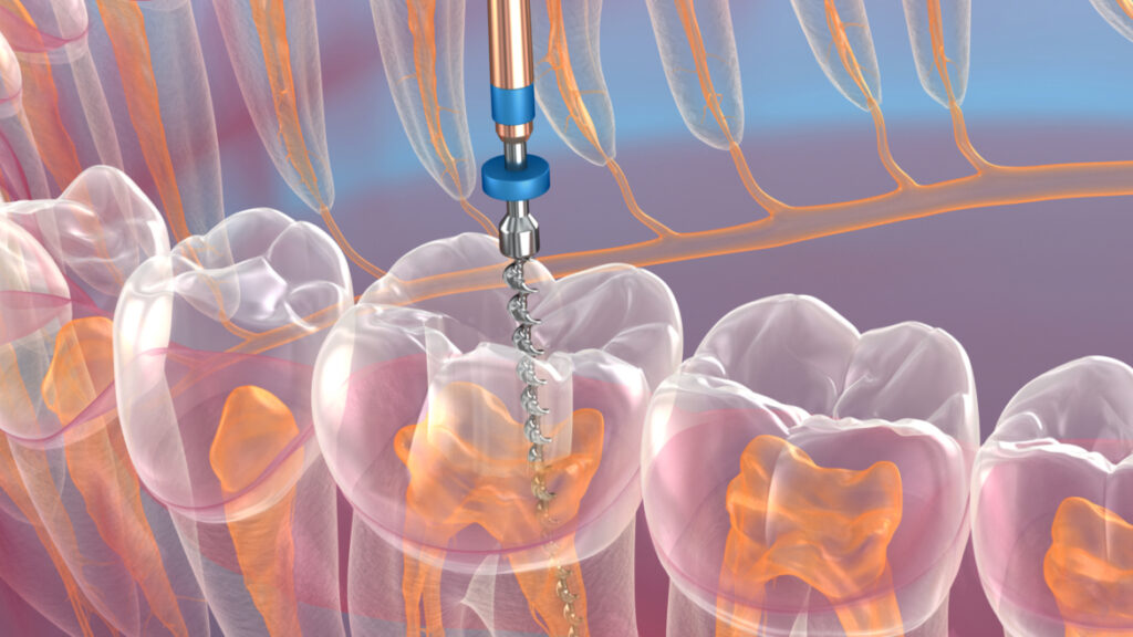 Le traitement de canal en Tunisie : quand est-il nécessaire et comment se déroule-t-il ? 