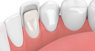 Facettes dentaires à Tunis : pour quel type de sourire ?