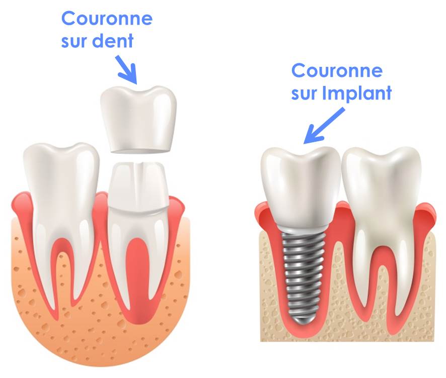 Couronne dentaire ou implant : quelle solution choisir ?