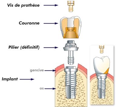 implant dentaire à tunis