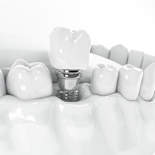 implant dentaire