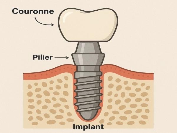 couronne-sur-implant-dentaire