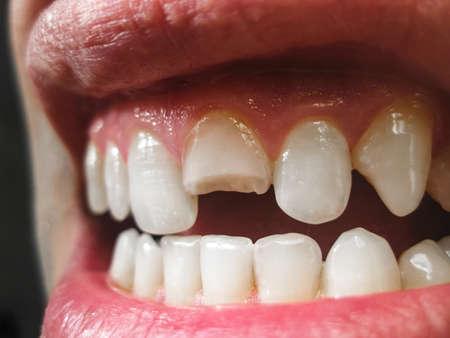 dent-abimee-couronne-dentaire