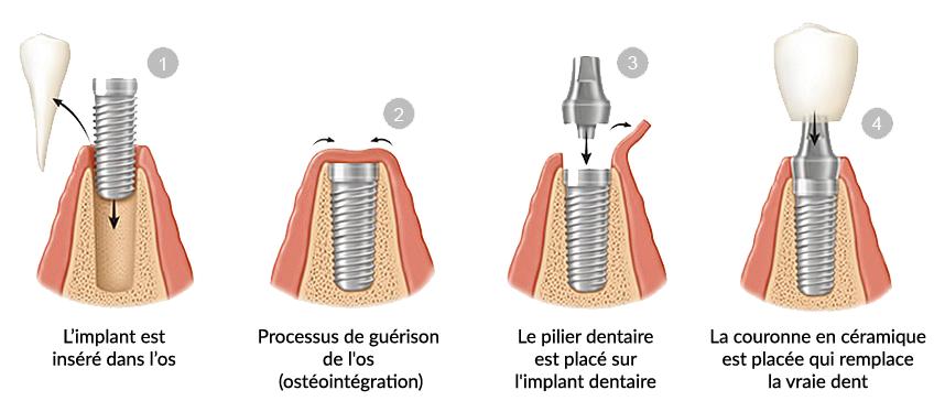 osteointegration-implant-dentaire