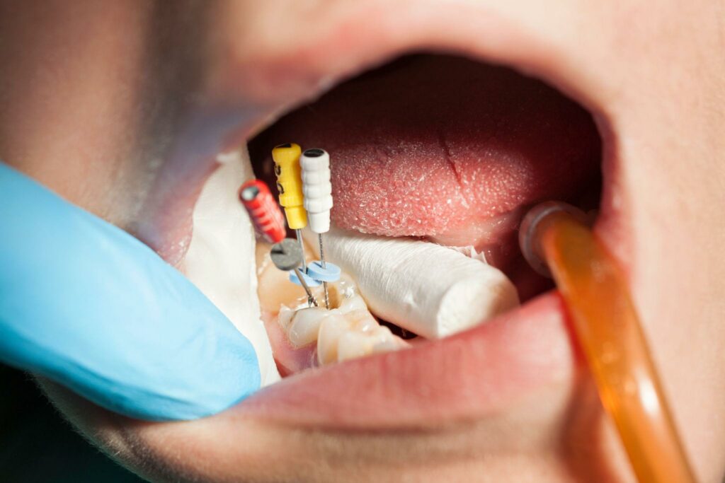 Natural tooth preserved after endodontic treatment