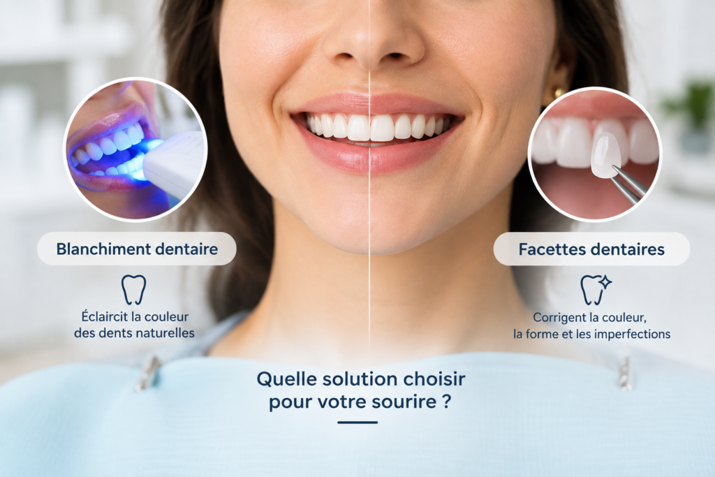Blanchiment dentaire ou facettes : quelle différence ?